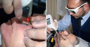 djupa rynkor, laserbehandling, dioxium advanced, victus clinic, laser