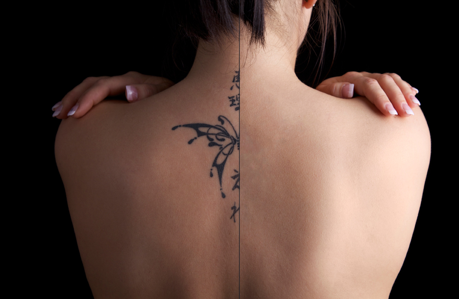 laserborttagning tatuering utbildning