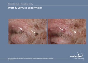 Wart & Verruca seborrhoica - Dermablate - Fraktionerad Laser