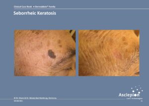 Seborrheic Keratosis - Dermablate - Fraktionerad Laser
