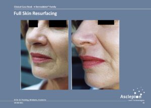 Full Skin Resurfacing - Dermablate - Fraktionerad Laser