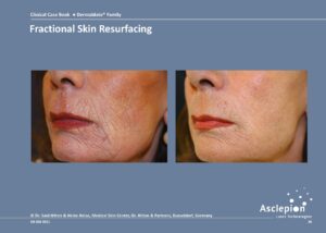 Fractional Skin Resurfacing - Dermablate - Fraktionerad Laser