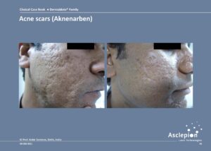 Acne scars - Dermablate - Fraktionerad Laser