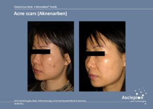 Acne scars - Dermablate - Fraktionerad Laser