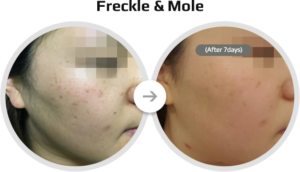 Freckle & Mole - Dual Accento Alexandritlaser